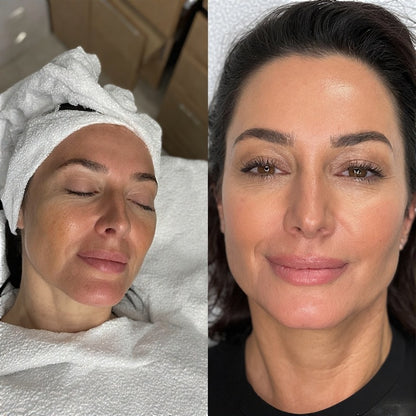 Peeling Pro Full-Face * CURSO ONLINE*